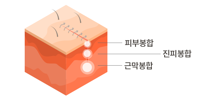 피부봉합, 진피봉합, 근막봉합의 피부 단면 설명
